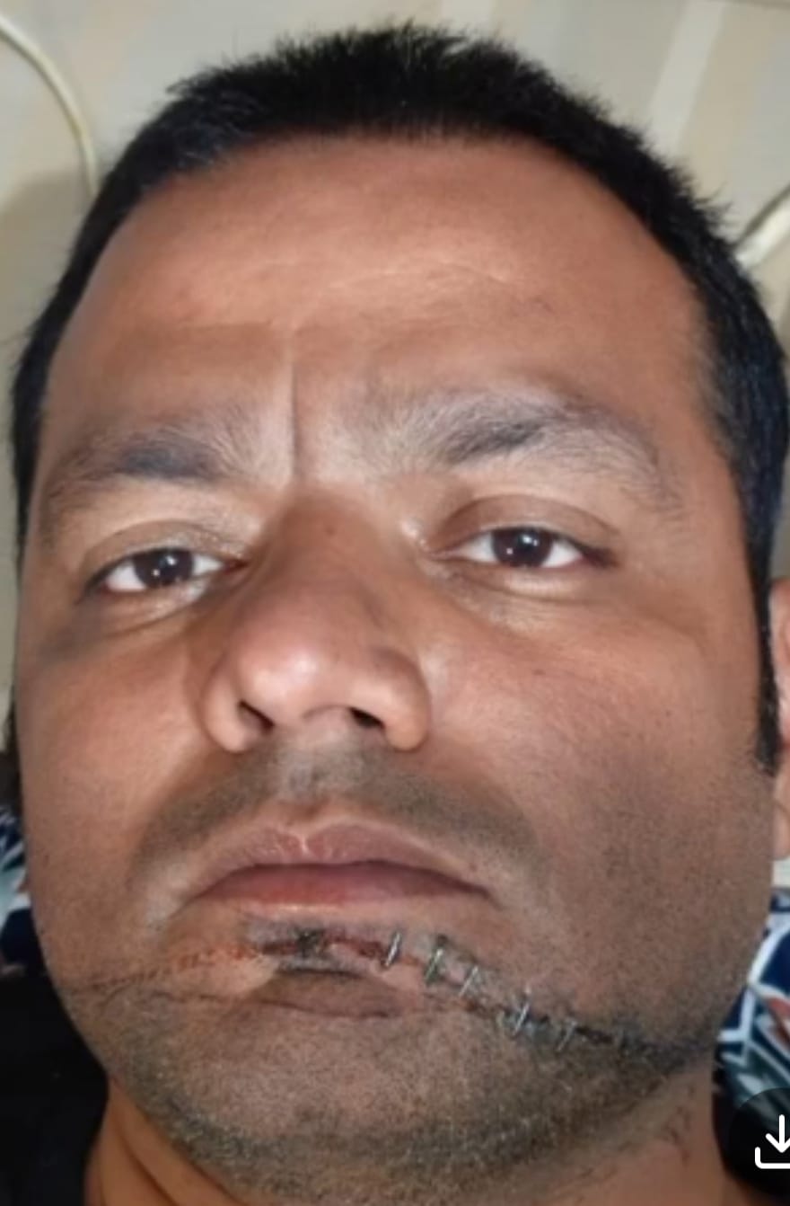 चाइनीज मांझे का कहर: बुलेट सवार कारोबारी का चेहरा कटा, सड़क पर गिरकर गंभीर घायल; गाल पर लगे 8 टांके